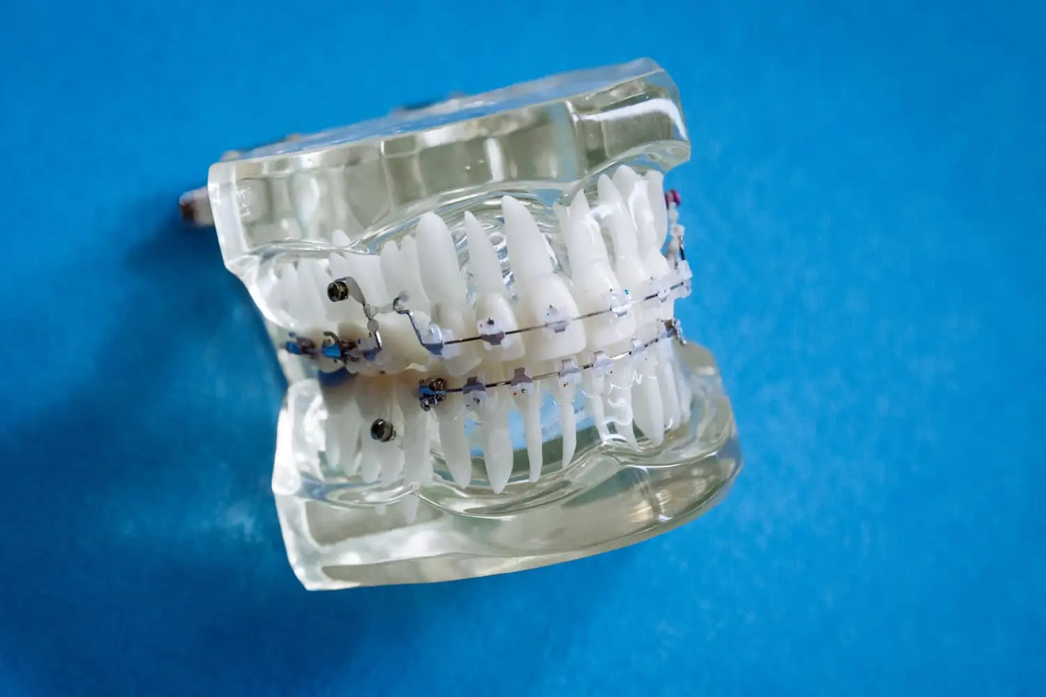 A dental model showcases clear and metal braces above a blue background at Lenius Orthodontics in Overland Park, KS.