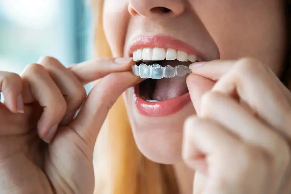 In Overland Park, KS, a person fits a clear aligner on their teeth, representing Invisalign Cost for Lenius Orthodontics.