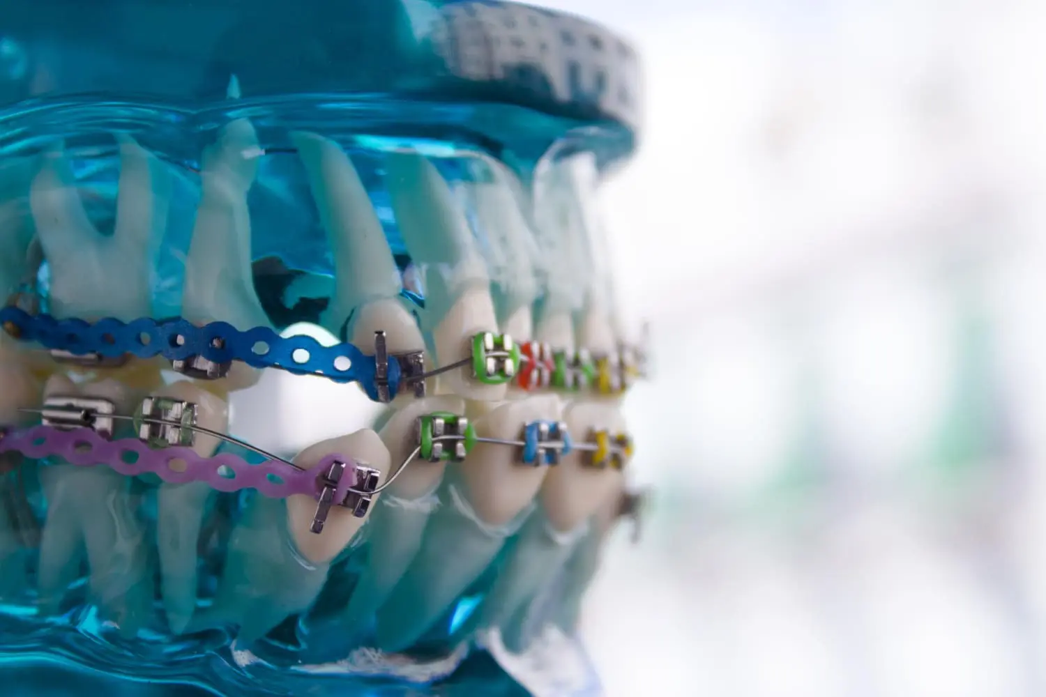A dental model at Lenius Orthodontics in Overland Park, KS shows metal braces and colorful bands for orthodontic demonstration.