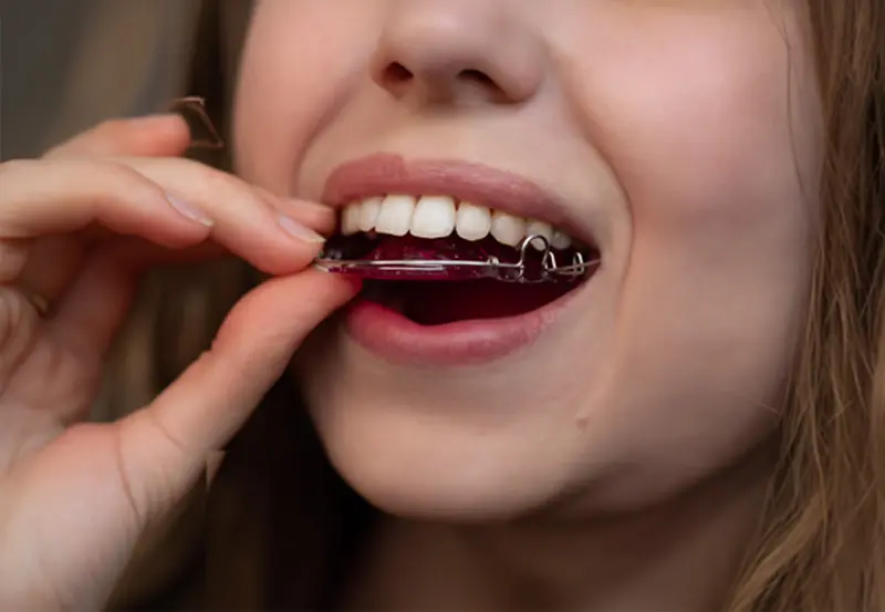A person inserts a teeth retainer into their mouth, displaying upper teeth at Lenius Orthodontics in Overland Park, KS.