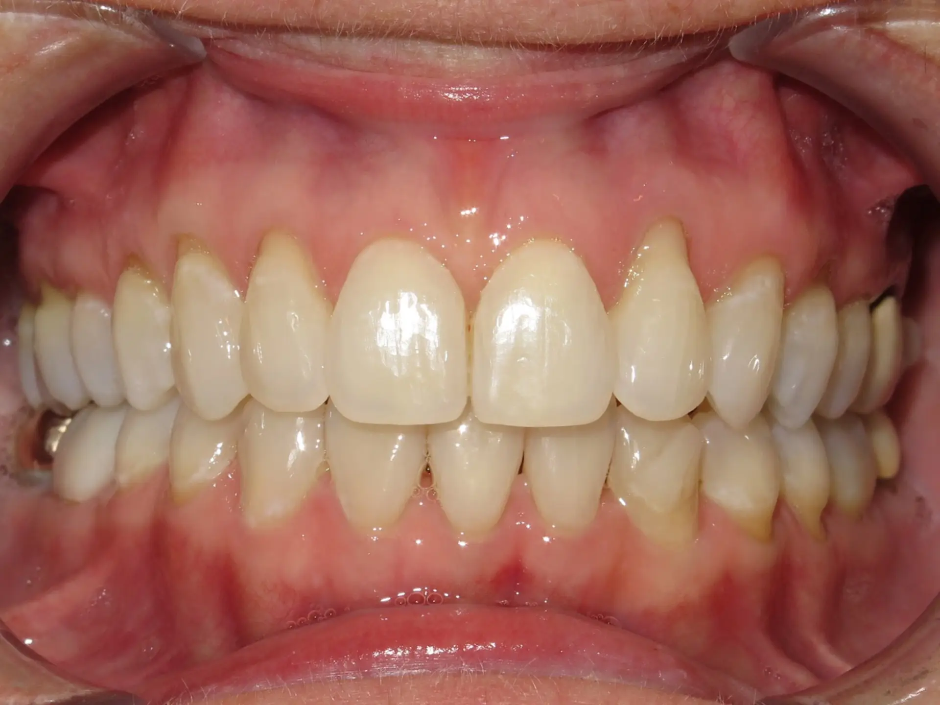 image representing after dental care with clear aligners at Lenius Orthodontics in Overland Park, KS.