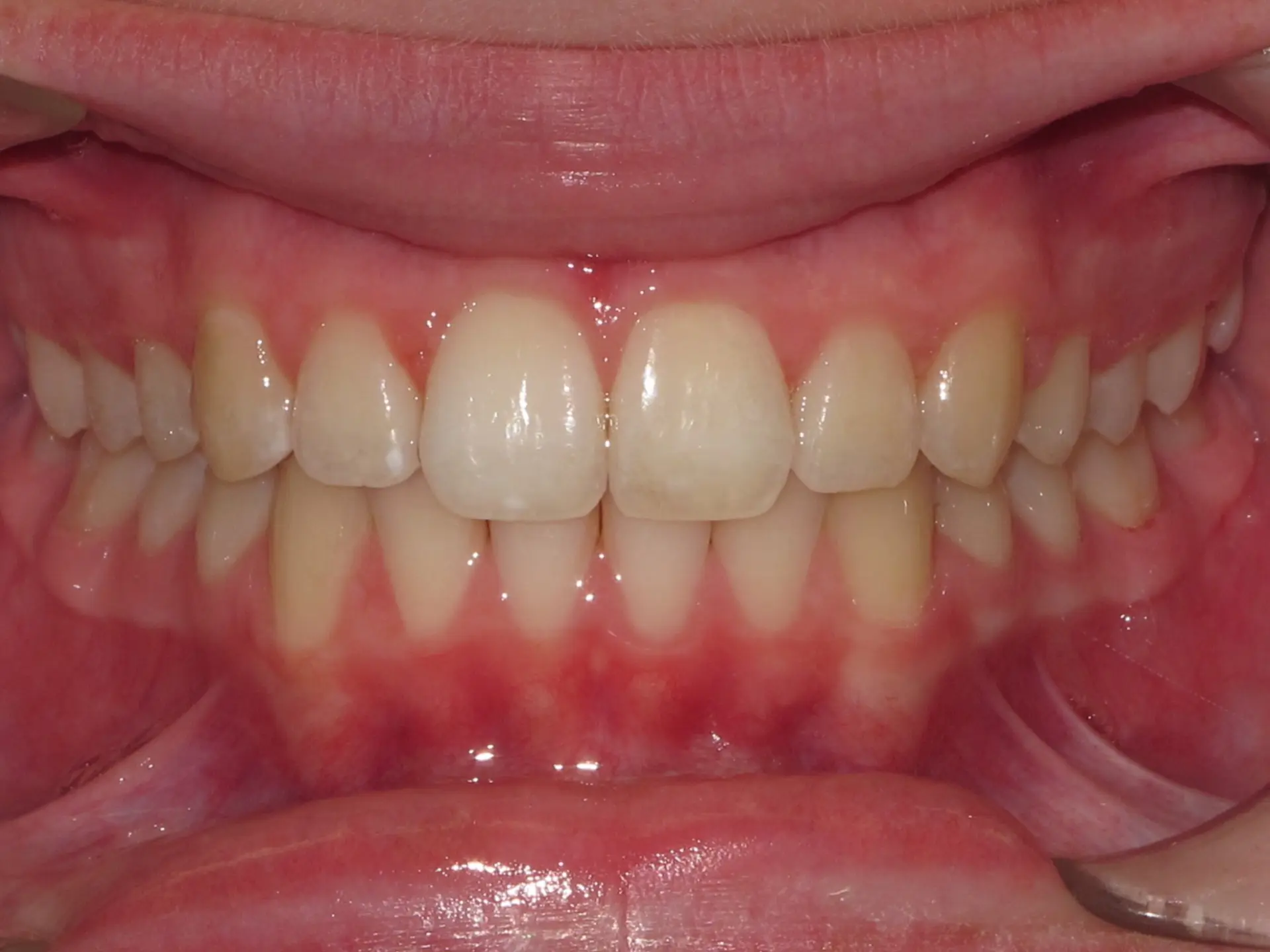 image representing after dental care with clear aligners at Lenius Orthodontics in Overland Park, KS.