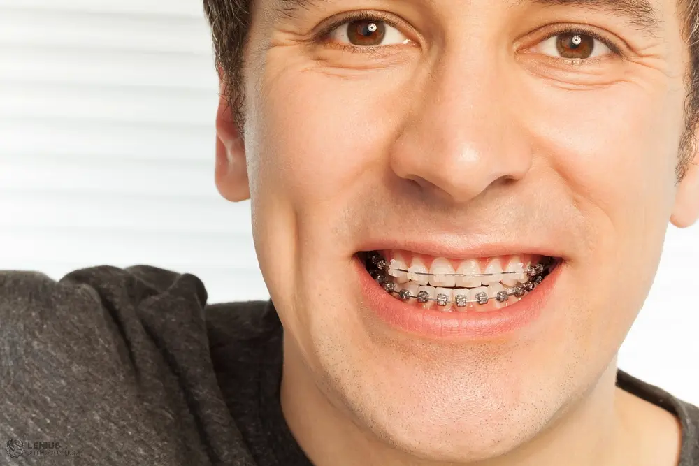 happy young man with metal braces - Overbite vs Underbite in Overland Park, KS