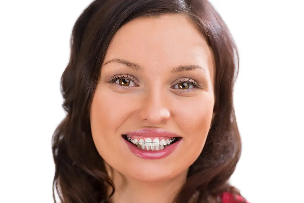 woman wearing orthodontic ceramic clear braces - Can Invisalign Fix Overbite in Overland Park, KS 
